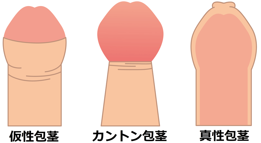 真性包茎 漫画 Amebaブログ