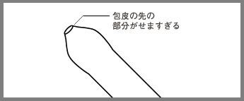 包茎とed Edとは 浜松町第一クリニック