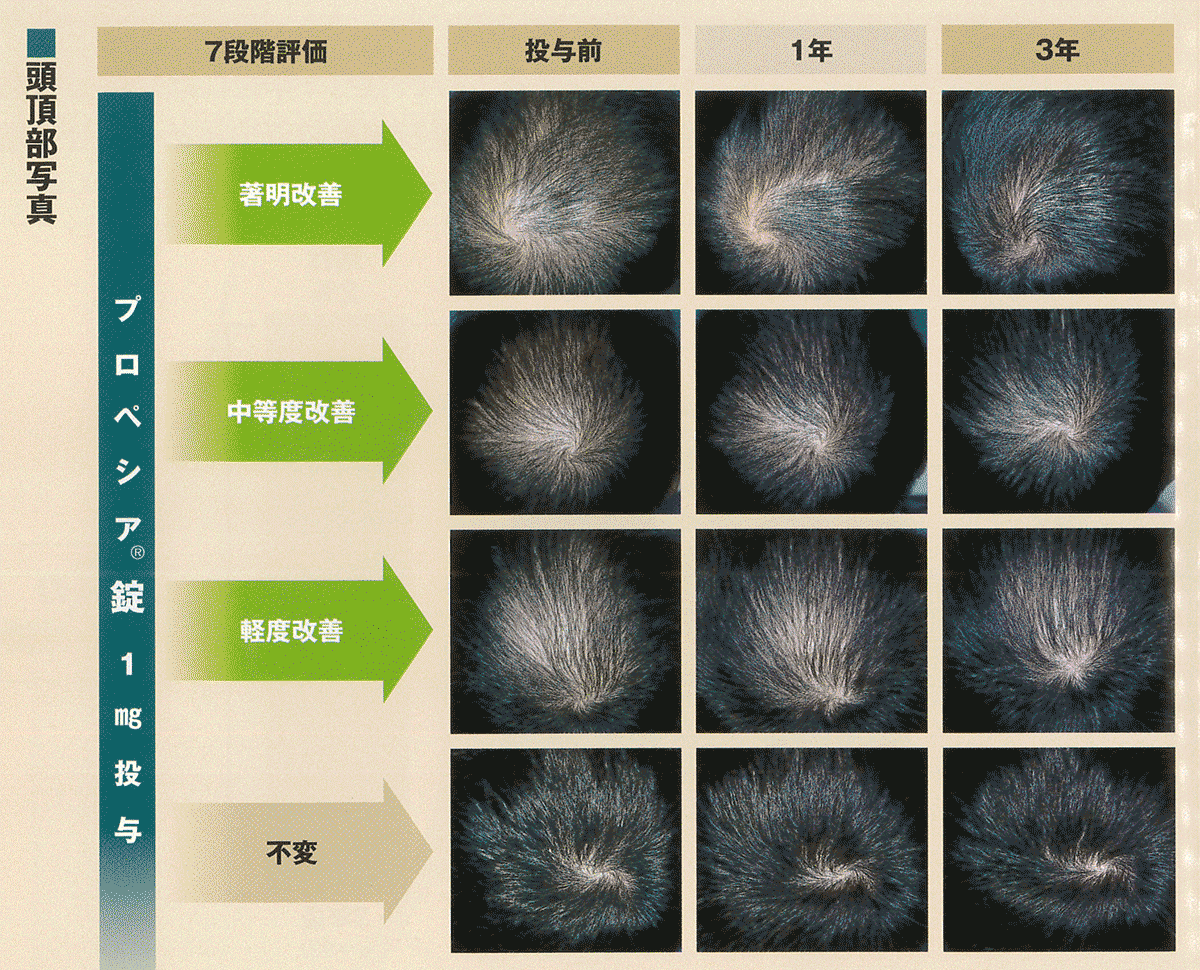 プロペシア錠の臨床効果 国内データ 3年 浜松町第一クリニック