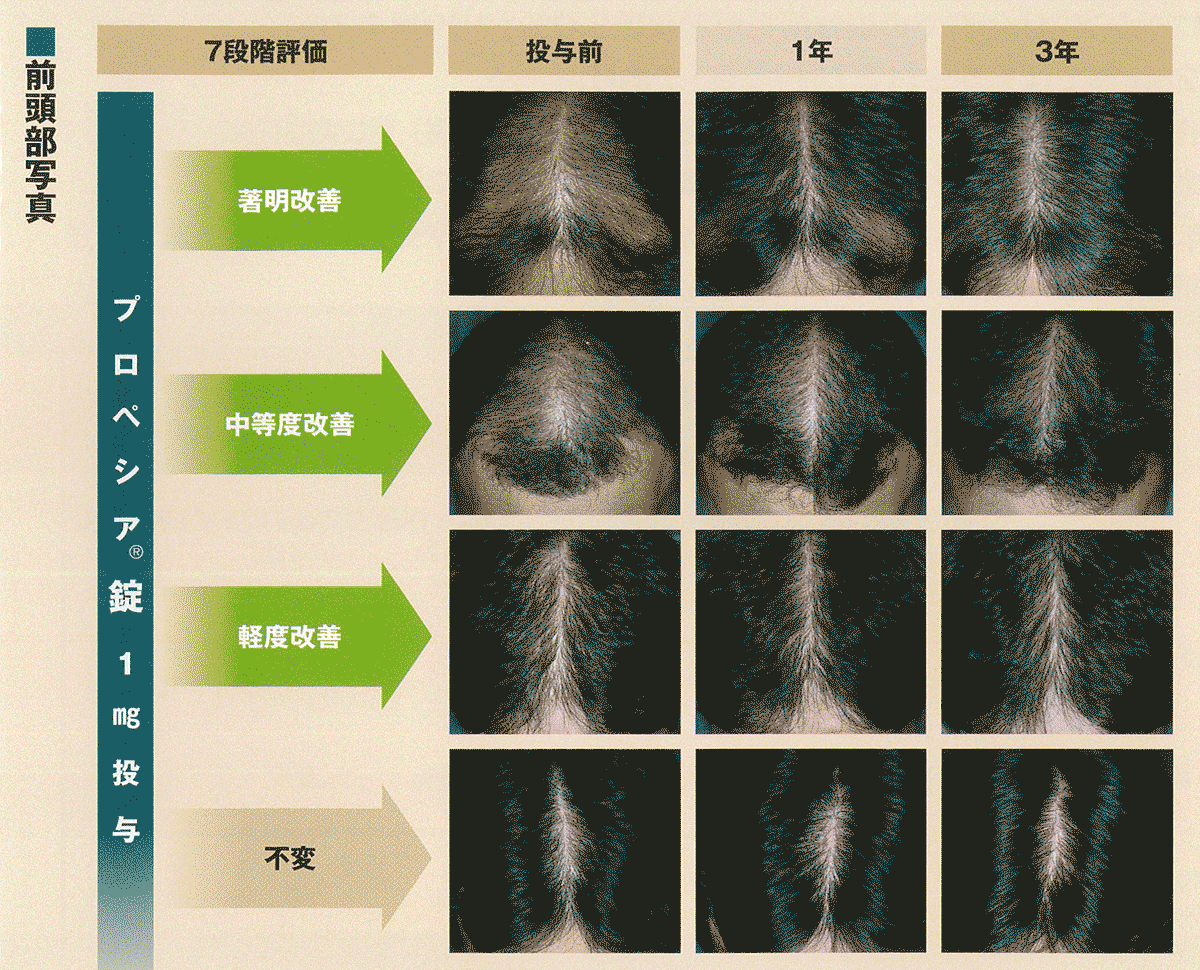 プロペシア錠の臨床効果 国内データ 3年 浜松町第一クリニック